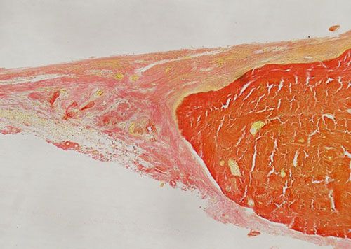 未脫鈣骨Van Gieson染色